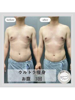 カラー(CALLA)/メンズにも大人気☆ウルトラ痩身