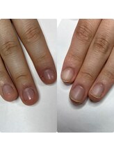 マニュコクーン(ManuCocoon)/爪育成　深爪　巻き爪　大阪市