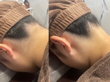 シェリール(Cherir)/うなじ脱毛