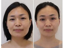 ドクターボディ 新宿店(Dr.Body)/【エラ/小顔/歪み　30代】