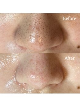 ミミ(mimi)/ビフォーアフター