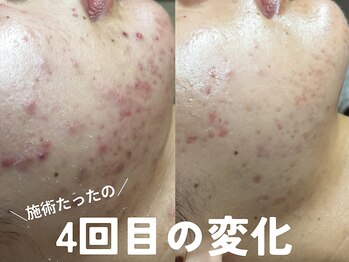 ホワイトアクア 鹿児島店(WHITE AQUA)/ハーブピーリング/肌質改善/荒田