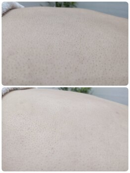 エステシェービングサロン フルール(Fleur)/背中のシェービング