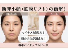 パイナップルピース(Pineapple Peace)/断罪小顔★