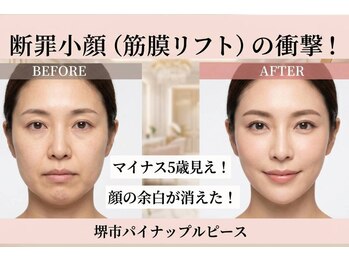 パイナップルピース(Pineapple Peace)/断罪小顔★