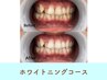 <医療提携>ホワイトニングコース ※スタッフ施術で安心