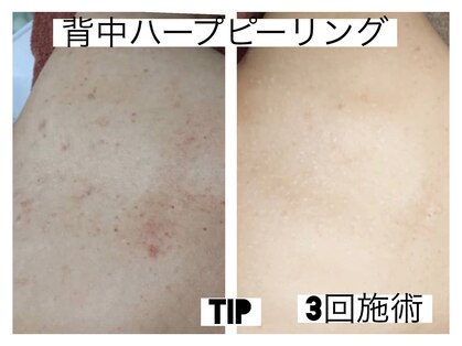 毛穴・エイジングケア専門｜ハーブピーリング｜salonsai｜シミ・美白・たるみの写真