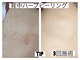 毛穴・エイジングケア専門｜ハーブピーリング｜salonsai｜シミ・美白・たるみの写真