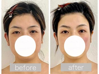 ステラルーテ(Stella lute)/脳洗浄4回集中改善コース 4回目