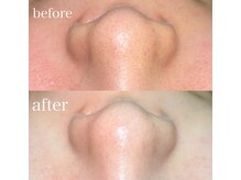 薫風/毛穴洗浄／20代