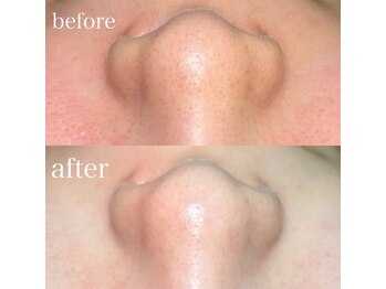 薫風/毛穴洗浄/20代