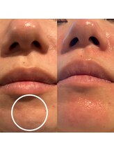 エミナル(Eminal)/◇毛穴エクストラクションtete式