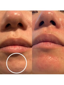 エミナル(Eminal)/◇毛穴エクストラクションtete式