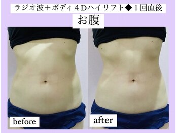 ルピナス ヒサヤ(LUPINUS hisaya)/4Dスーパーリフトはボディにも☆