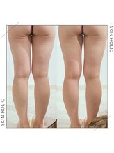 スキンホリック 恵比寿駅前店(SKIN HOLIC)/下半身☆痩身ビフォア＆アフター