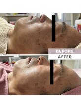 とぅるりん 肌質改善/ターンオーバー促進！！