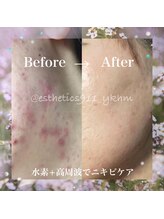 エステティックス ナインワンワン 横浜(Esthetics911) /ニキビケア、フェイシャル