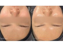 ルシェリア(Le cherien)/即効艶肌ハーブピーリング☆