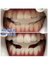 実夢(miyu)/美容ジェル・ビフォーアフター