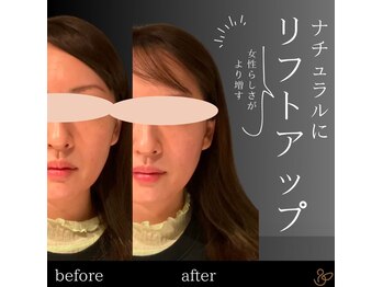 チョコバリ 郡山店(chocobari)/小顔×リフトアップ(美容鍼)20代