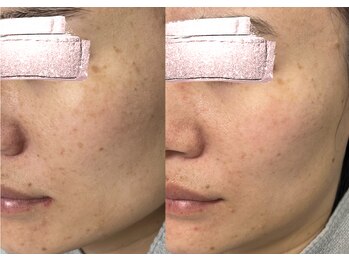 モガナ(mogana)/30代・シミケア3回