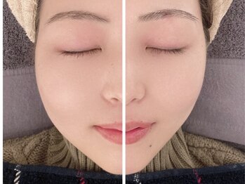 アンドグレイスプラス 恵比寿(&Grace+)の写真/医療提携の技術で小顔を目指す！一度で変化を実感しやすい特別なケアを体験♪