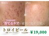 【9月限定】夏の紫外線ダメージ＆肌荒れ撃退◎トロイピール￥22000→￥19000
