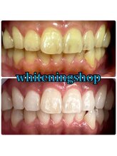 ホワイトニングショップ 天王寺店/40分照射×10回 40代女性