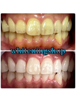 ホワイトニングショップ 天王寺店/40分照射×10回 40代女性