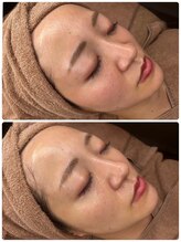 プロット 大阪本店(plot)/LDM・ララピール 施術　