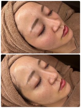 プロット 大阪本店(plot)/LDM・ララピール 施術　