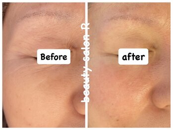 ビューティサロン アール(R)/お目元のシワ改善