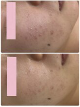 レイビス 仙台店(RAYVIS)/ニキビケアに！小顔効果も♪4