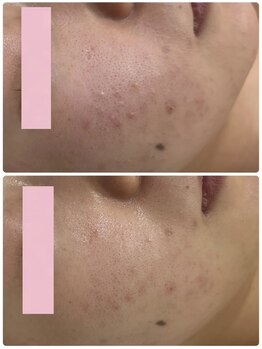 レイビス 仙台店(RAYVIS)/ニキビケアに！小顔効果も♪4