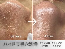 ブルームーン(Blue Moon)の雰囲気（AHA・BHAピーリング成分配合の美容液で優しく毛穴の汚れを除去）