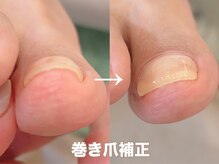 ネイルサロンアンドスクール シーグリーン(SEAGREEN)の雰囲気（皮膚に食い込む痛い巻き爪も巻き爪専用ジェルで補正できます♪）