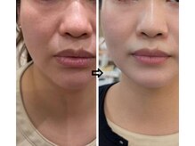 プリマプリート 大垣店/マリオネットラインと法令線に♪