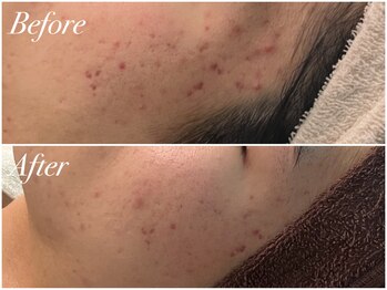 アンドナイン エス店(ANDNINE.)/20代ハーブピーリング4回