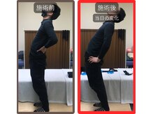 まこと整骨院/尻もち後の激烈な腰痛の整体　１