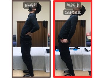 まこと整骨院/尻もち後の激烈な腰痛の整体　１