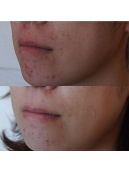 トラット エステアンドアイズ(tratto)/30代　お客様症例写真