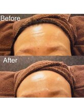 ブランシェ 富山店 × 椿/シワ・たるみケア　お客様