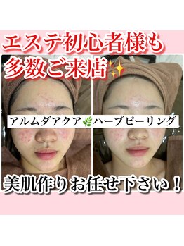 ホワイトアクア 新宿本店(WHITE AQUA)/ハーブピーリング/東京/新宿