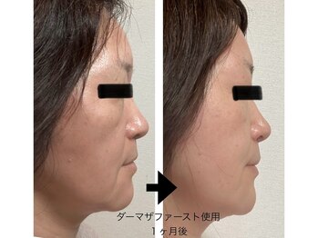 エメ 心斎橋(Aimer)/たるみブラックハーブピーリング