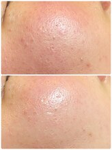 ソルエユニーク(Le seul et unique)/ワックス×ハーブピーリング★