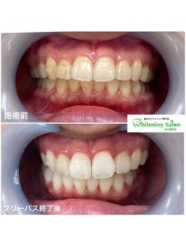 ホワイトニングサロン 名古屋駅店/【ホワイトニング施術例】
