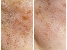 シュエット(chouette)の雰囲気（【before→after】人気メニューのシミケアで続々効果出てます◎）