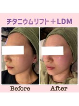 エスポワ/チタニウムリフト