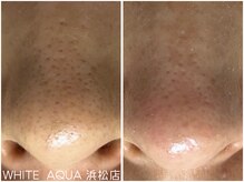 ホワイトアクア 浜松店(WHITE AQUA)/毛穴ケア/毛穴洗浄/浜松