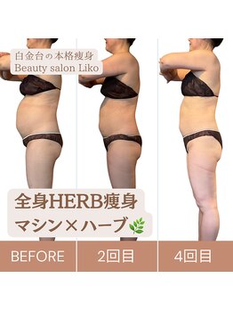 リコ 白金台(Liko)/全身ハーブ痩身 BeforeAfter